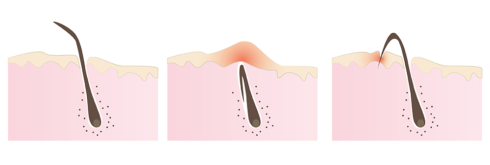 Poil incarné : définition, symptômes, diagnostic et traitement