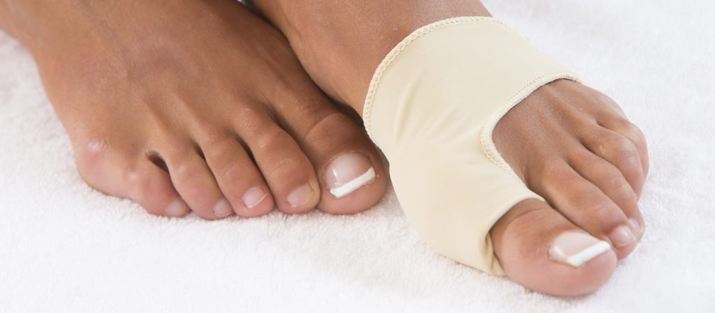 hallux valgus